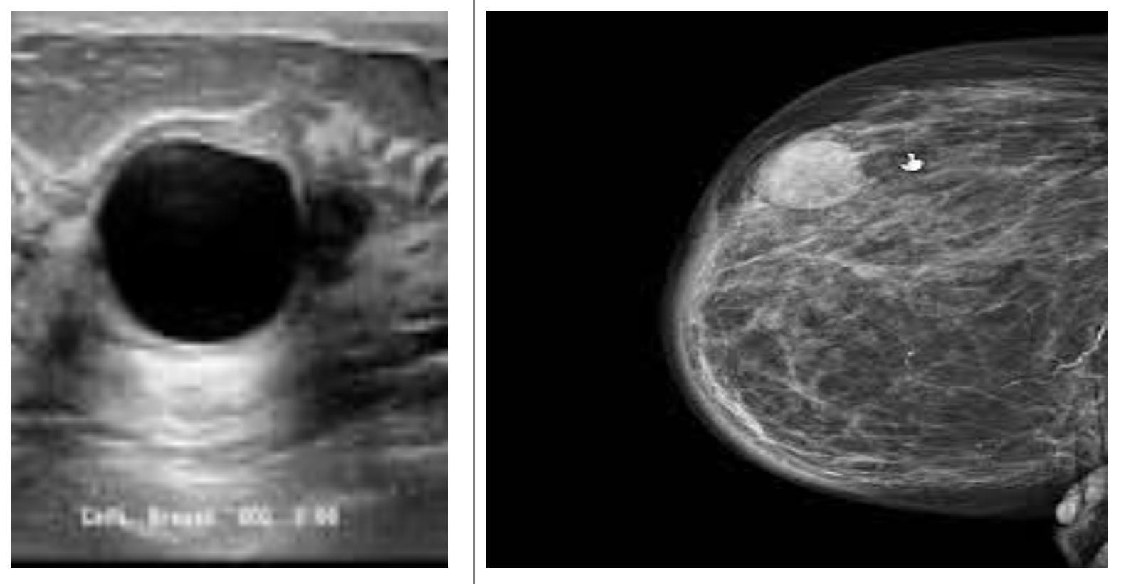 breast cyst on ultrasound and mammogram