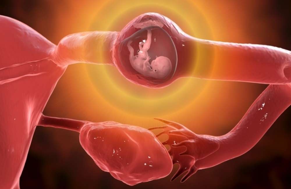 Ectopic Pregnancy – Causes and Treatment