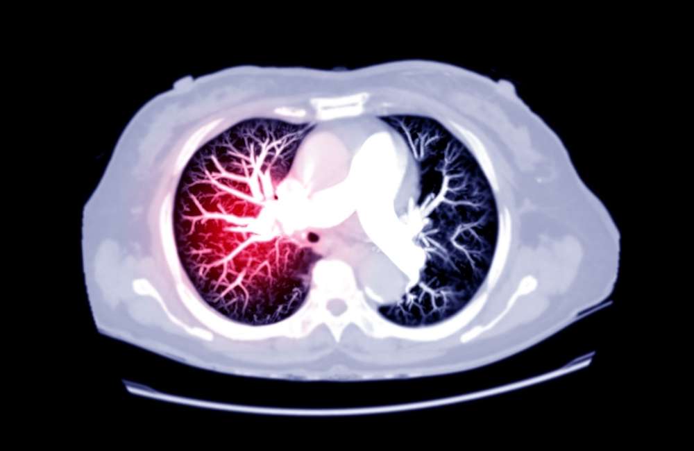 Pulmonary Embolism – Symptoms and Treatment