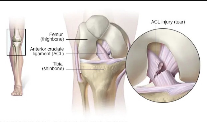 anterior cruciate ligament (ACL) injury