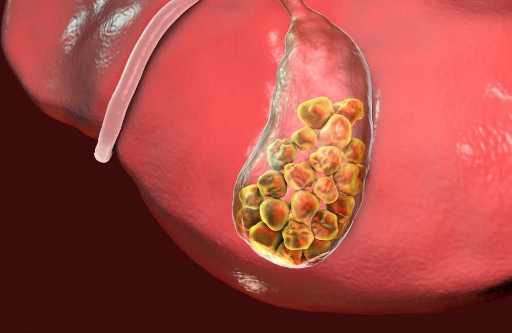 Gallstones – Causes and Treatment