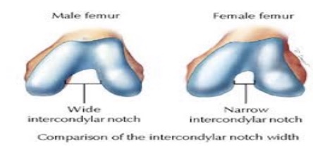 male femur vs female femur - ACL injury