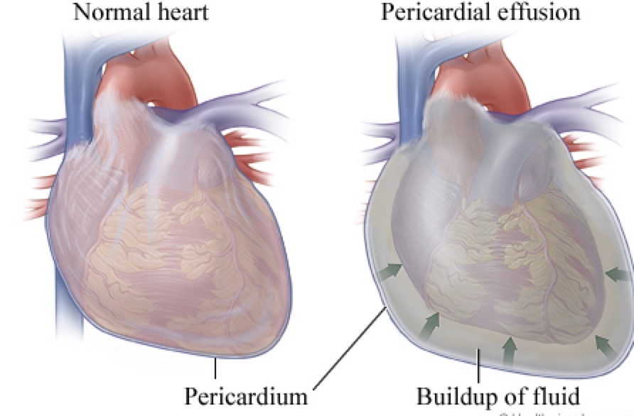 Pericardial Effusion – Causes and Treatment