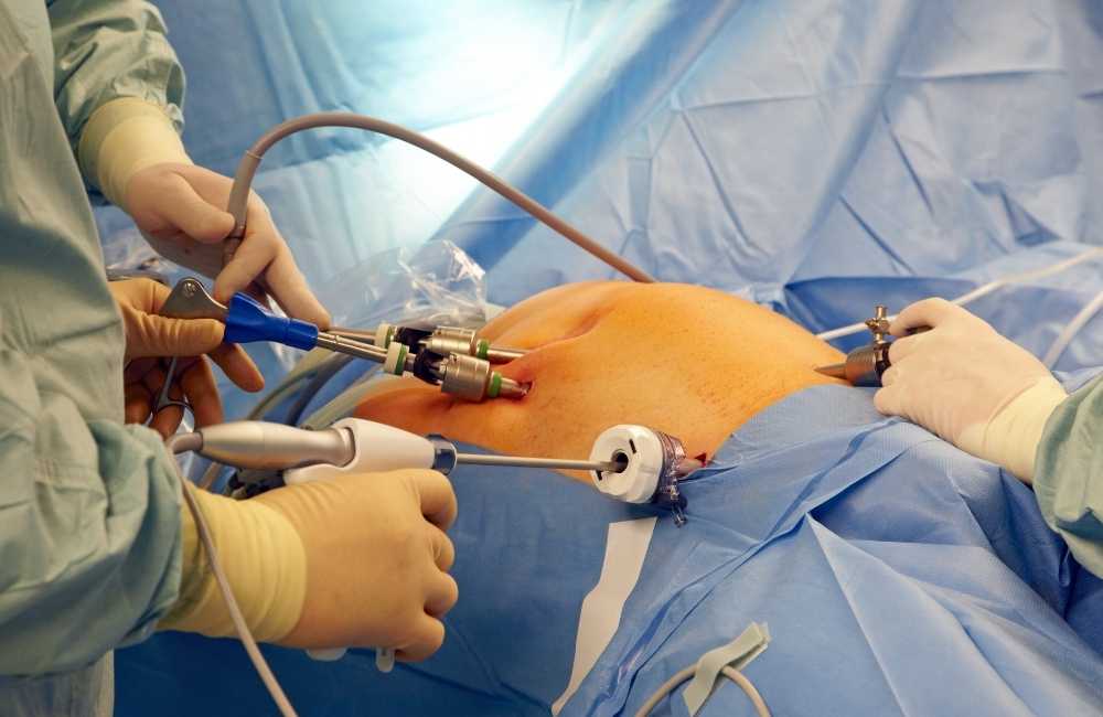 surgery to remove gallstones