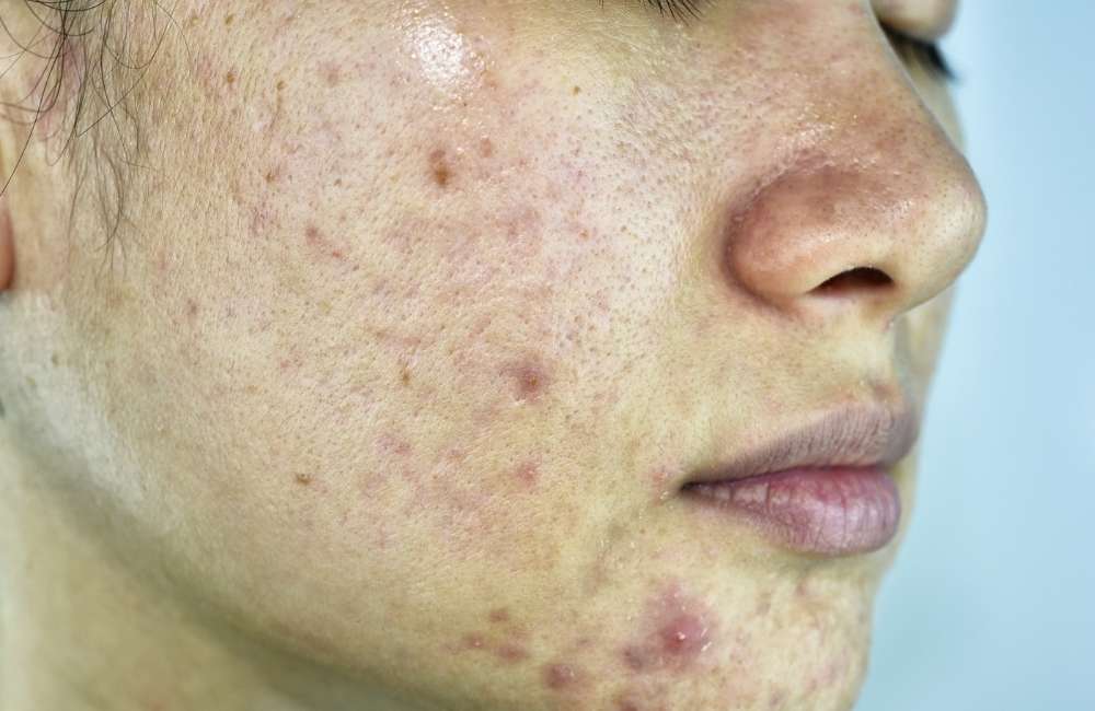 acne vulgaris symptoms