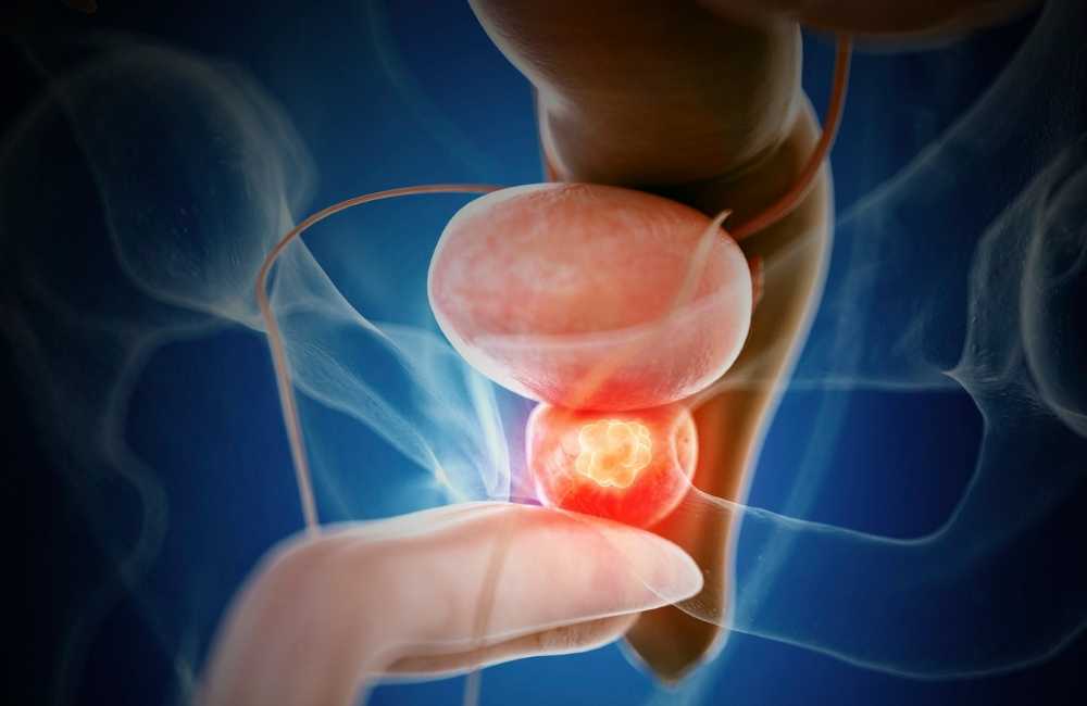 Cancer of the prostate (CAP) – Symptoms and Treatment
