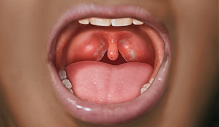 Tonsillitis – All You Need to Know