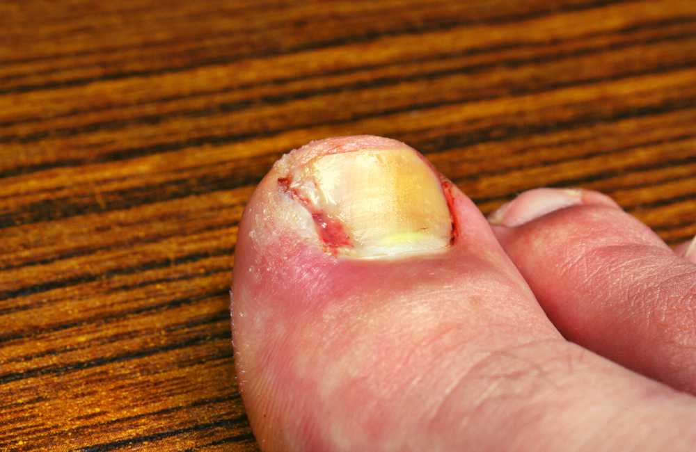 Ingrown toenail – Causes and Treatment