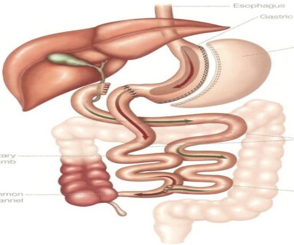 biliopancreatic diversion with duodenal switch