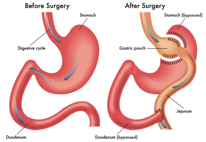 gastric bypass before and after surgery