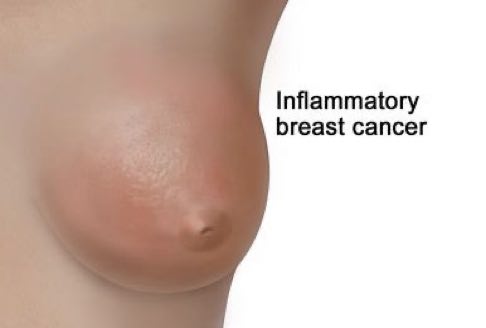 inflammatory breast cancer