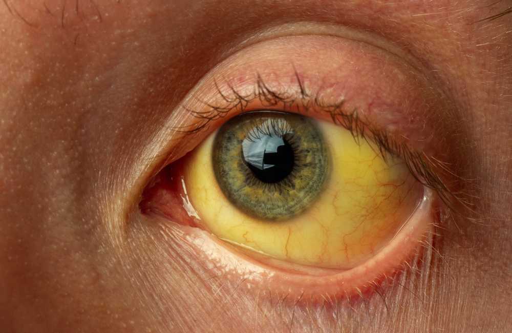 A person's eye that appear yellow due to jaundice