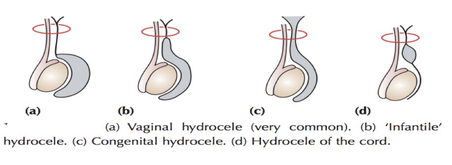 types of primary hydrocele