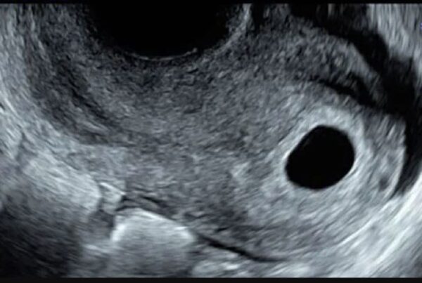 ultrasound image of anembryonic pregnancy