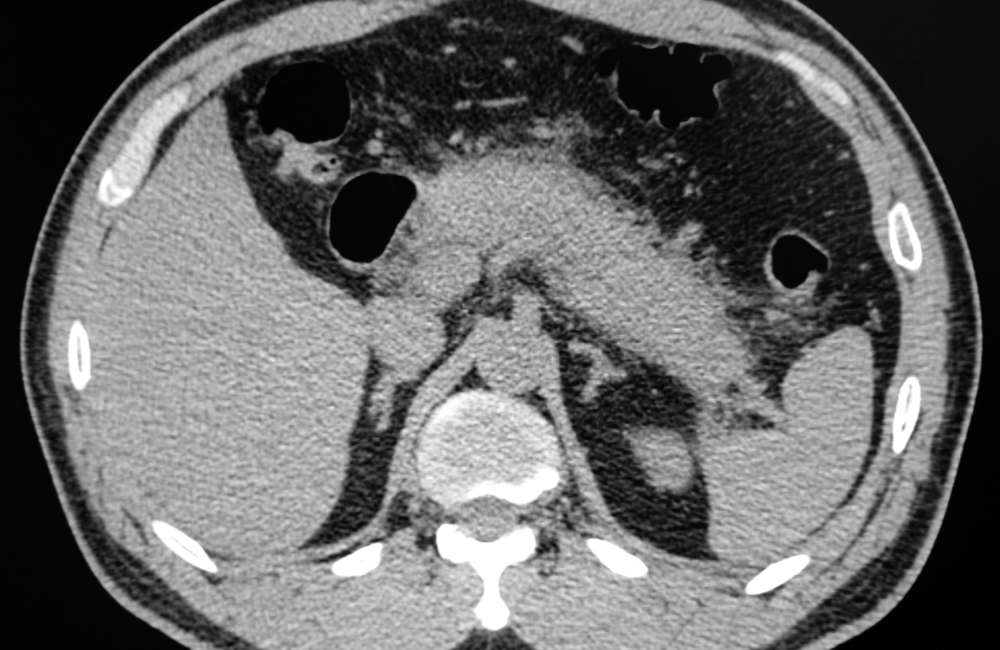 ultrasound scan showing acute pancreatitis